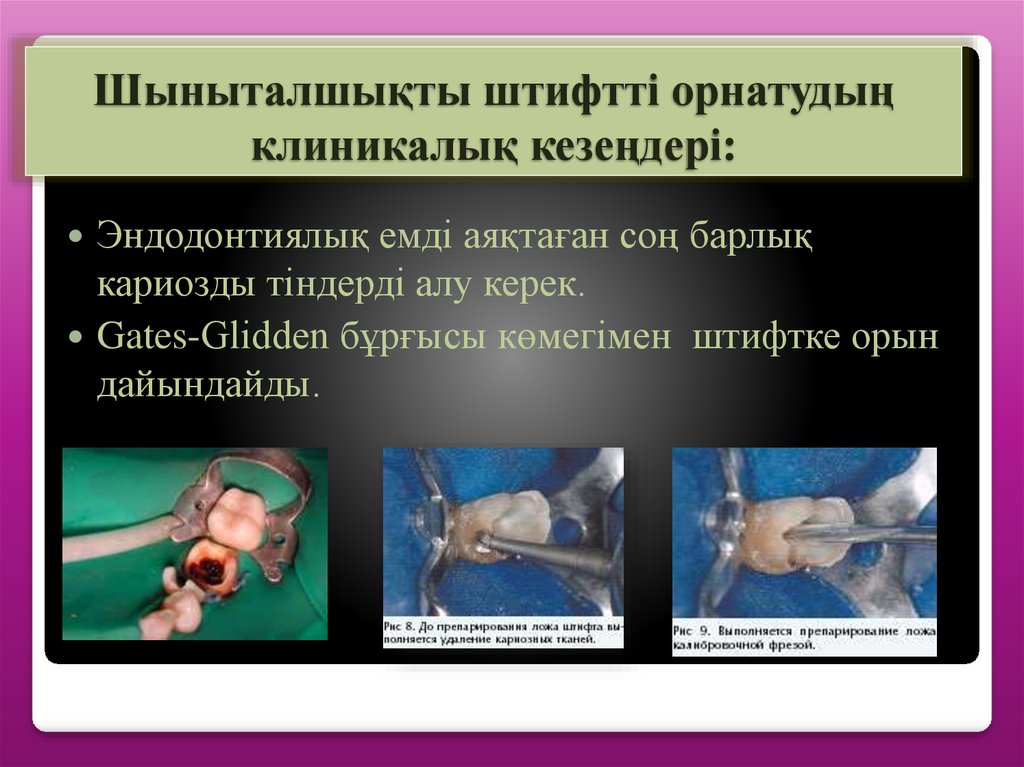 Шыныталшықты штифтті орнатудың клиникалық кезеңдері: