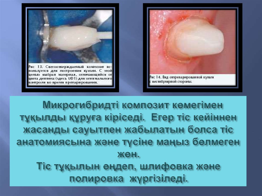 Микрогибридті композит көмегімен тұқылды құруға кіріседі. Егер тіс кейіннен жасанды сауытпен жабылатын болса тіс анатомиясына