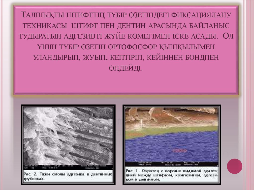 Талшықты штифттің түбір өзегіндегі фиксациялану техникасы штифт пен дентин арасында байланыс тудыратын адгезивті жүйе көмегімен