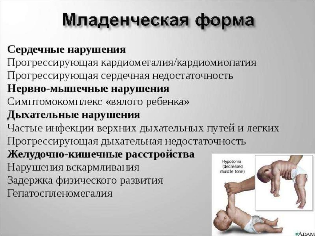 Болезнь помпе картинки