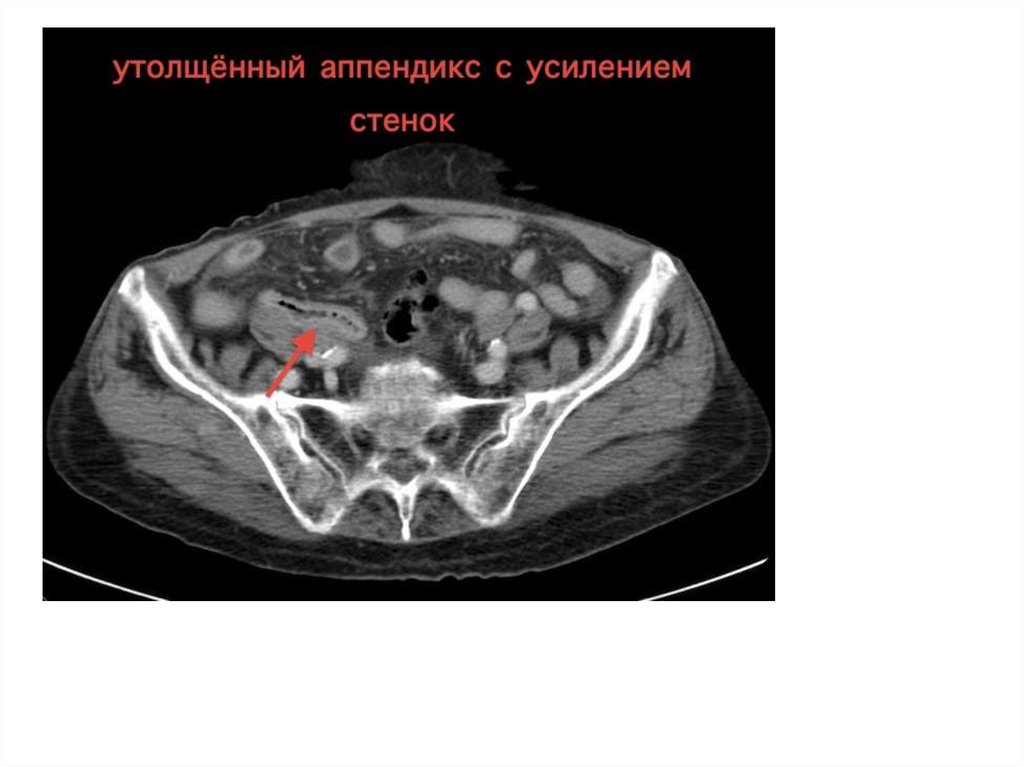 Аппендикулярный инфильтрат кт картина