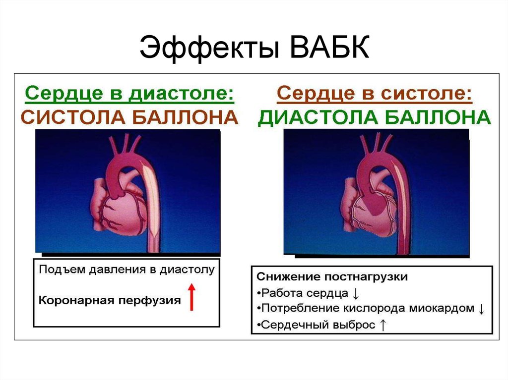 Острое сердце. Внутриаортальный баллонный контрпульсатор. Осложнения ВАБК. ВАБК В кардиологии. Противопоказания к ВАБК.