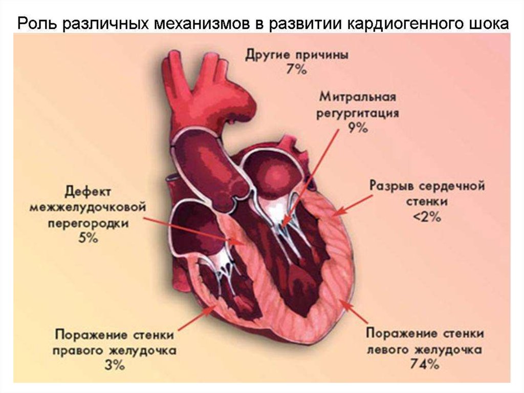 Разрыв межжелудочковой перегородки. Кардиогенный ШОК. Сердце при кардиогенном шоке. Кардиогенный ШОК причины.
