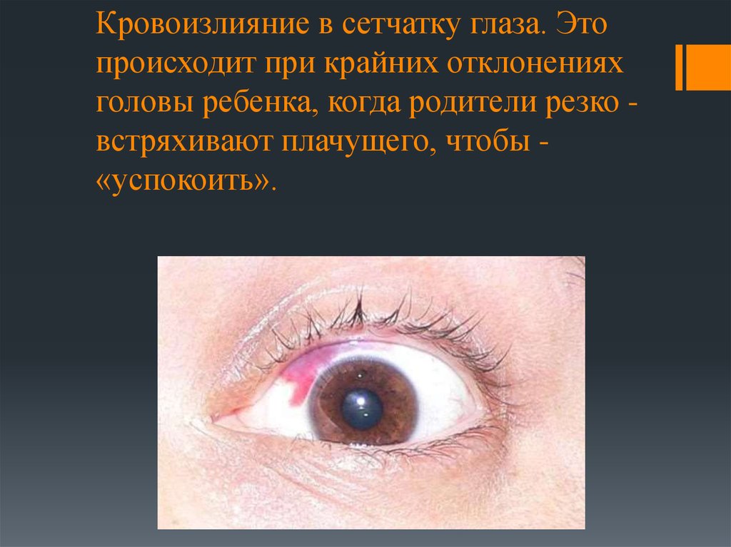 Кровоизлияние в сетчатку глаза. Это происходит­ при­ крайних­ отклонениях­ головы­ ребенка,­ когда­ родители­ резко