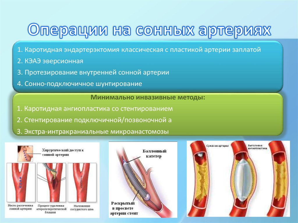 Шунтирование артерий нижних конечностей