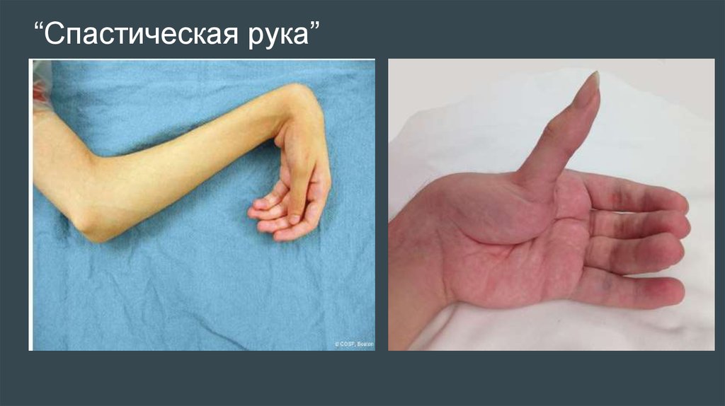 “Спастическая рука”