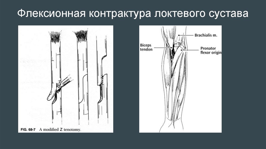 Разработать контрактуру