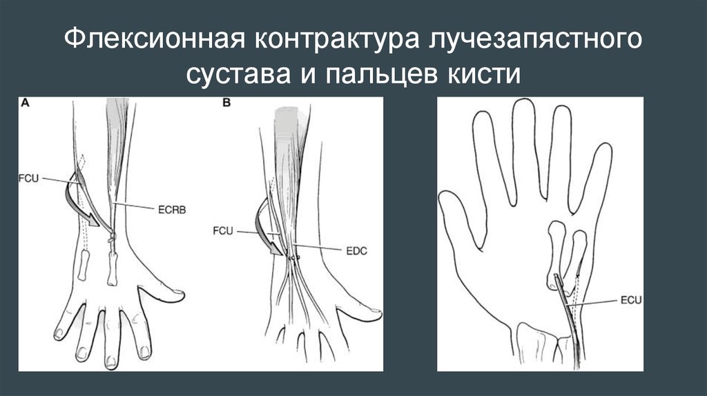 Посттравматический контрактура сустава