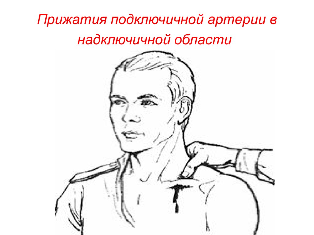 Прижатие сонной. Пальцевое прижатие подключичной артерии. Техника пальцевого прижатия подключичной артерии. Место прижатия подключичной артерии при кровотечении. Точка пальцевого прижатия подключичной артерии.