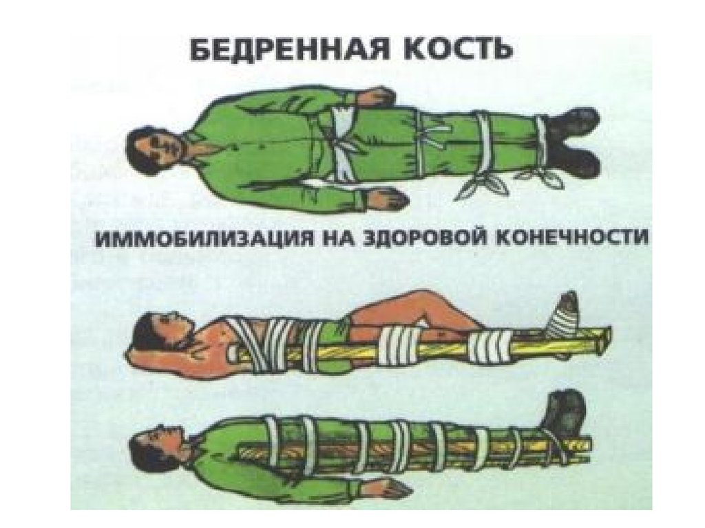 Открытый перелом бедра первая помощь. Транспортная иммобилизация при переломе бедренной кости. Иммобилизация пострадавшего при переломе верхней конечности. Транспортная иммобилизация при переломе костей голени бедра. Иммобилизация при переломе бедренной кости.