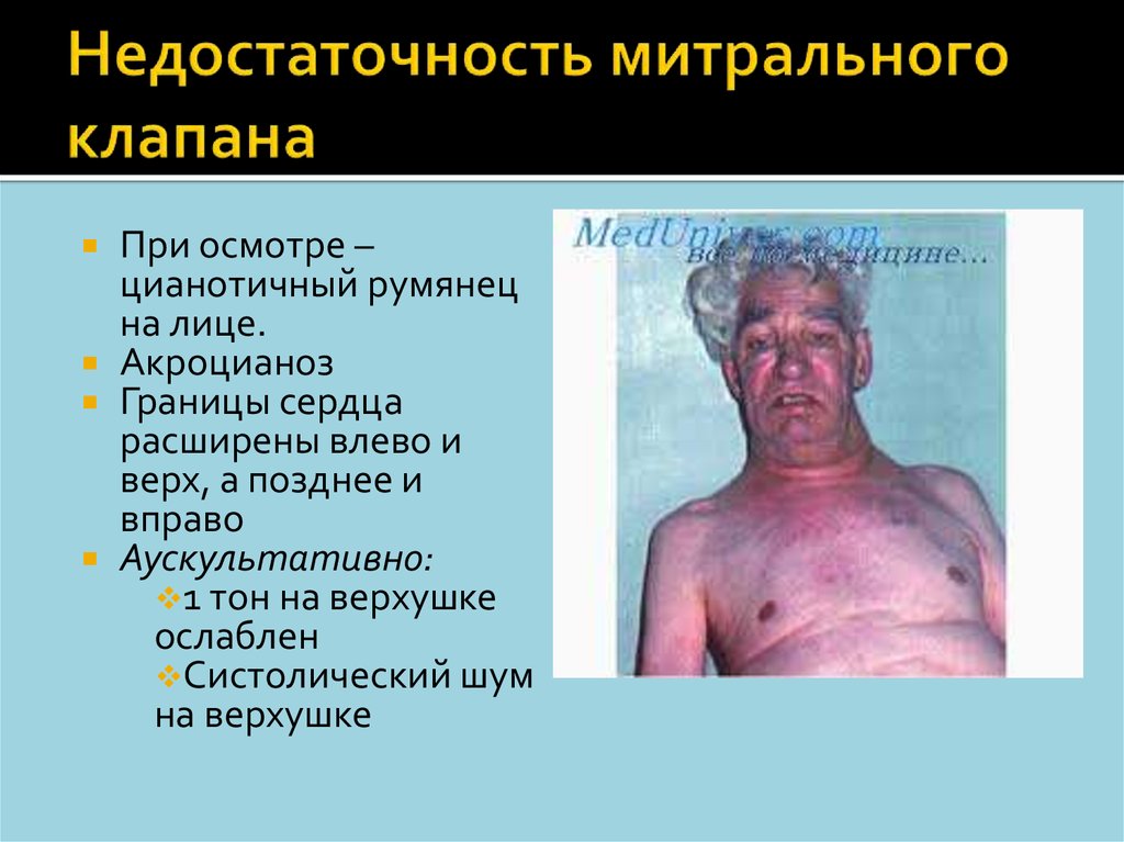 Недостаточность митрального клапана