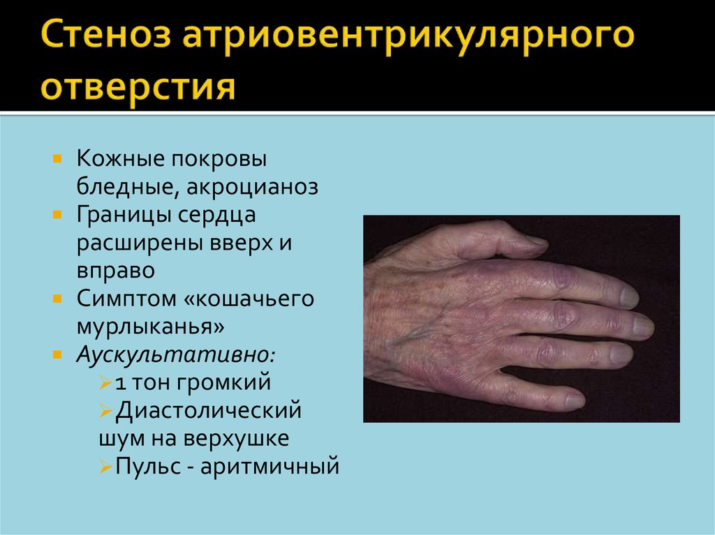 Стеноз атриовентрикулярного отверстия