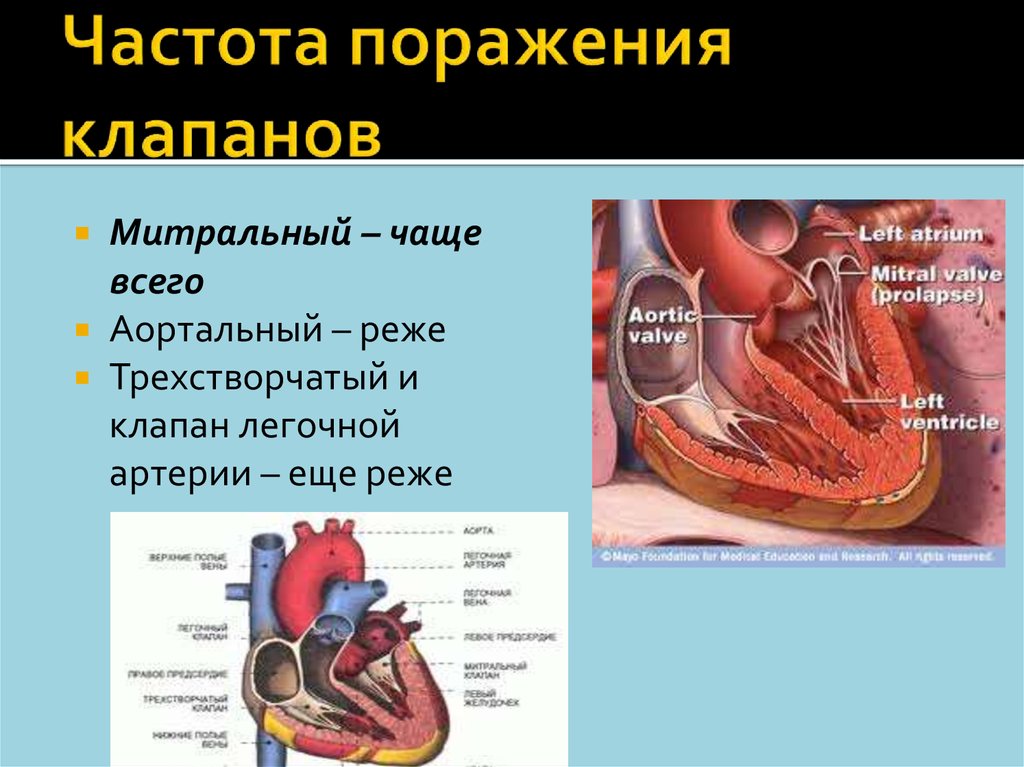 Поражение митрального клапана. Митральный клапан трехстворчатый клапан. Клапаны сердца митральный аортальный трехстворчатый. Аортальный клапан и трикуспидальный. Митральный клапан и аортальный клапан.