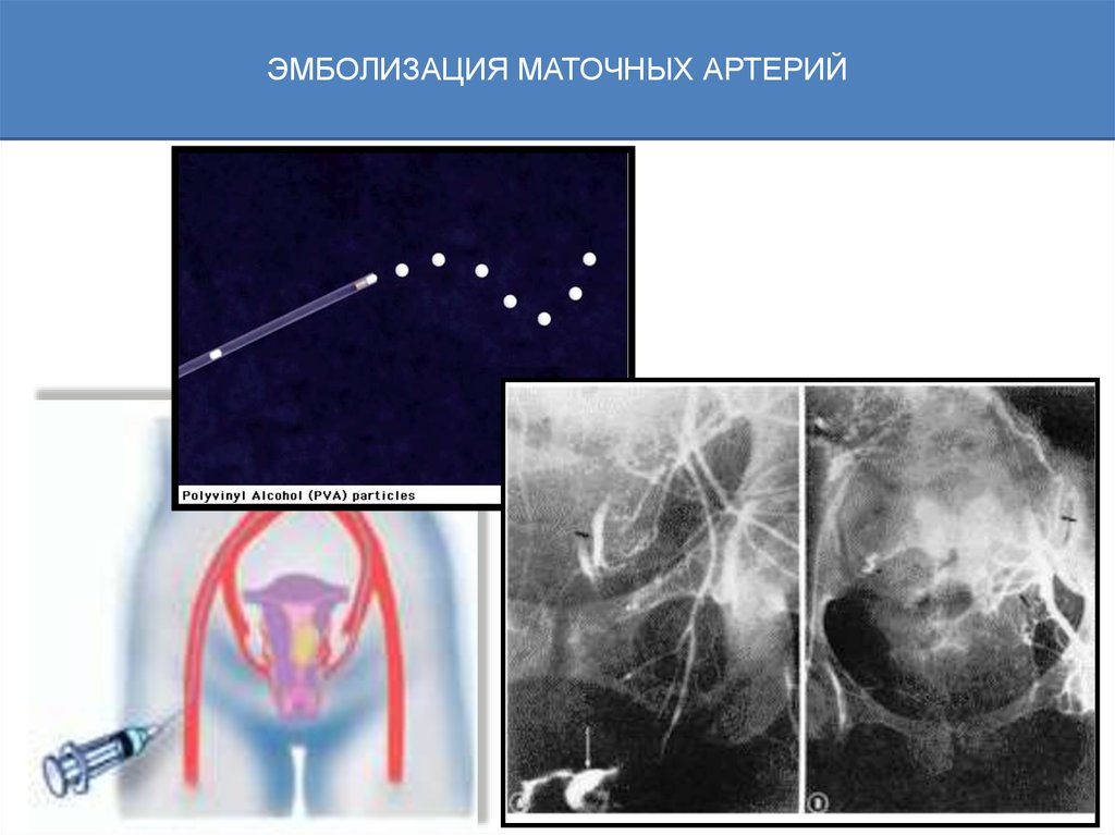 Эмболизация маточных артерий. Эмболизация маточных сосудов. Эмболизация маточных артерий Эма. Эмболизация ветвей маточных артерий. Эмболизация маточных труб.