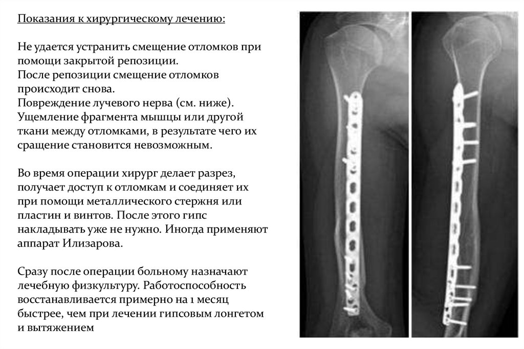 Открытая репозиция костей