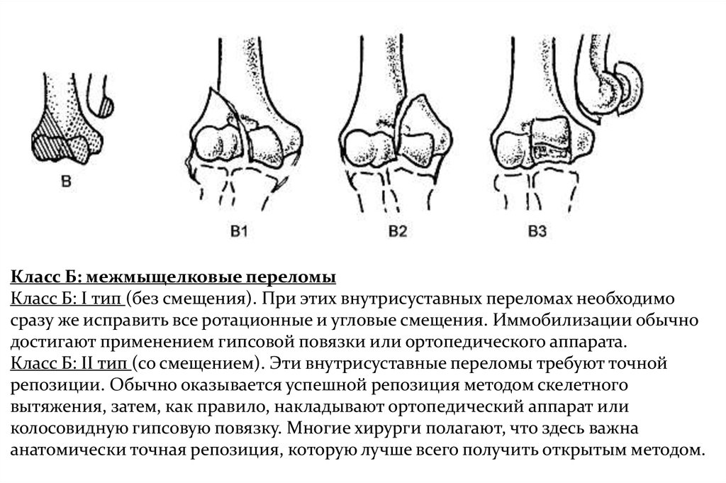 Внутрисуставной перелом. Межмыщелковый перелом. Межмыщелковый перелом плечевой кости. Латеральная межмыщелковая перегородка.