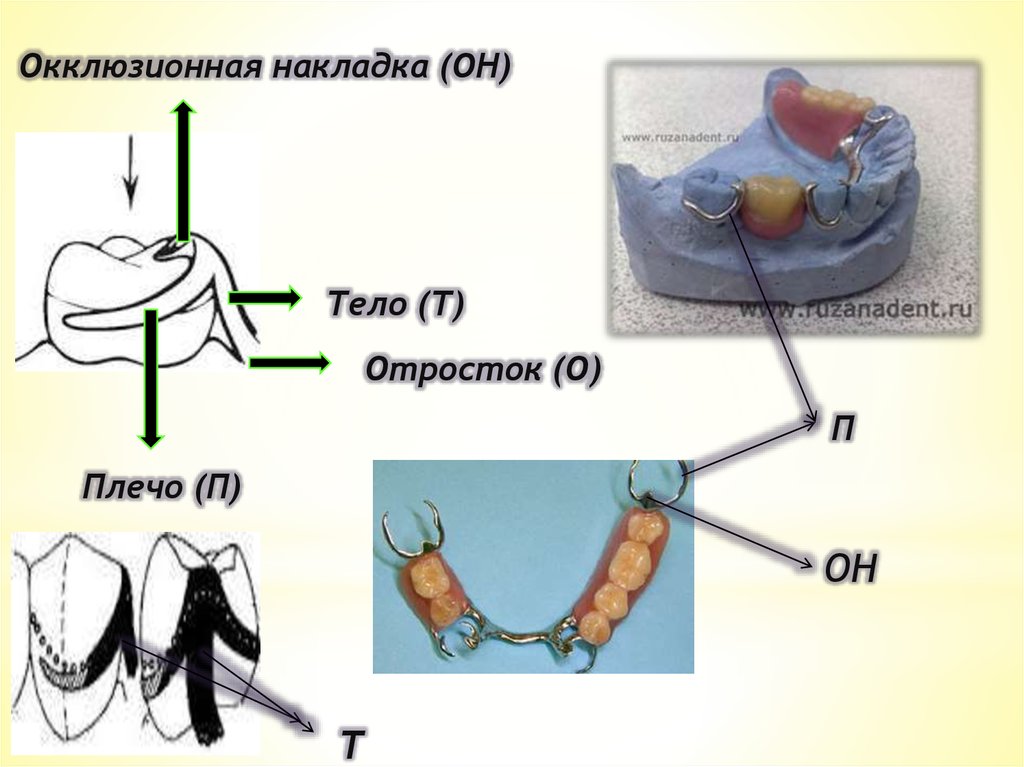 Строение бюгельного протеза. Окклюзионные накладки бюгельного протеза. Строение кламмера бюгельного. Элементы кламмера бюгельного протеза. Строение кламмера протеза.