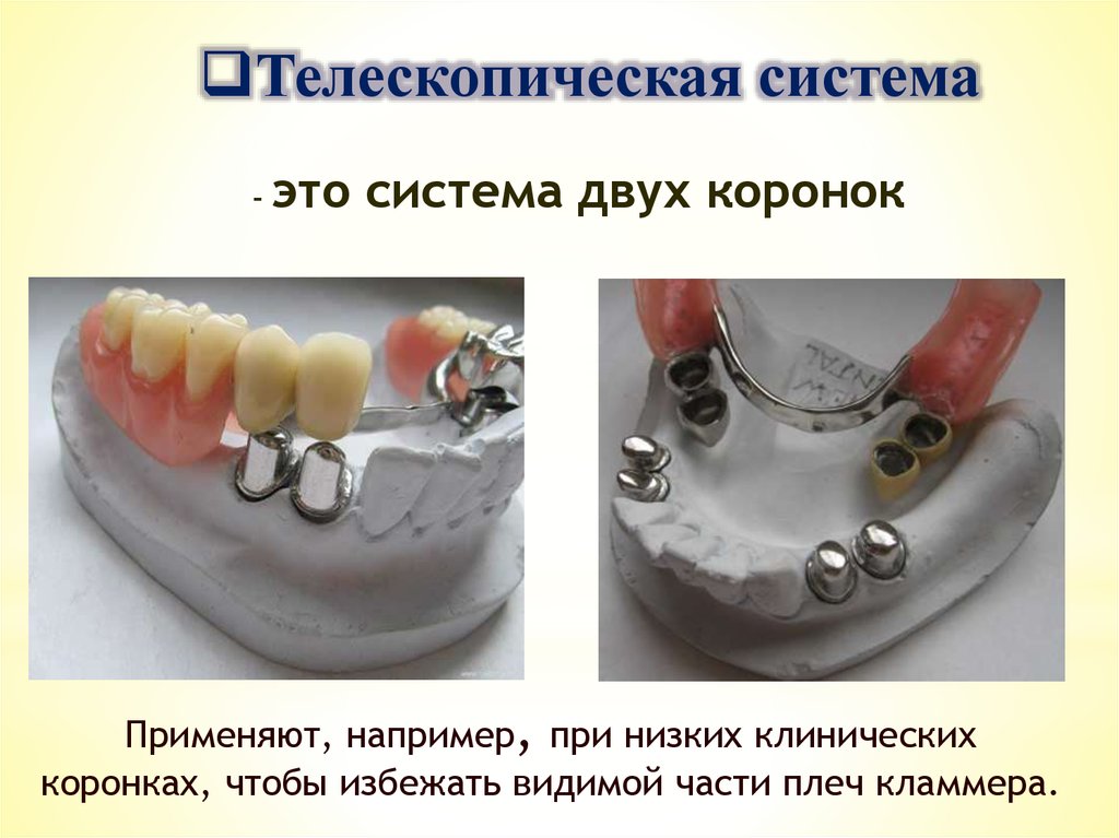 Телескопическая фиксация бюгельного протеза