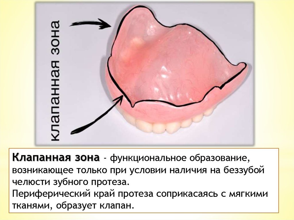 Переходная складка слизистой. Клапанная зона полного съемного протеза. Клапанная зона в стоматологии. Клапанная зона это понятие. Фиксация протезов на беззубых челюстях.