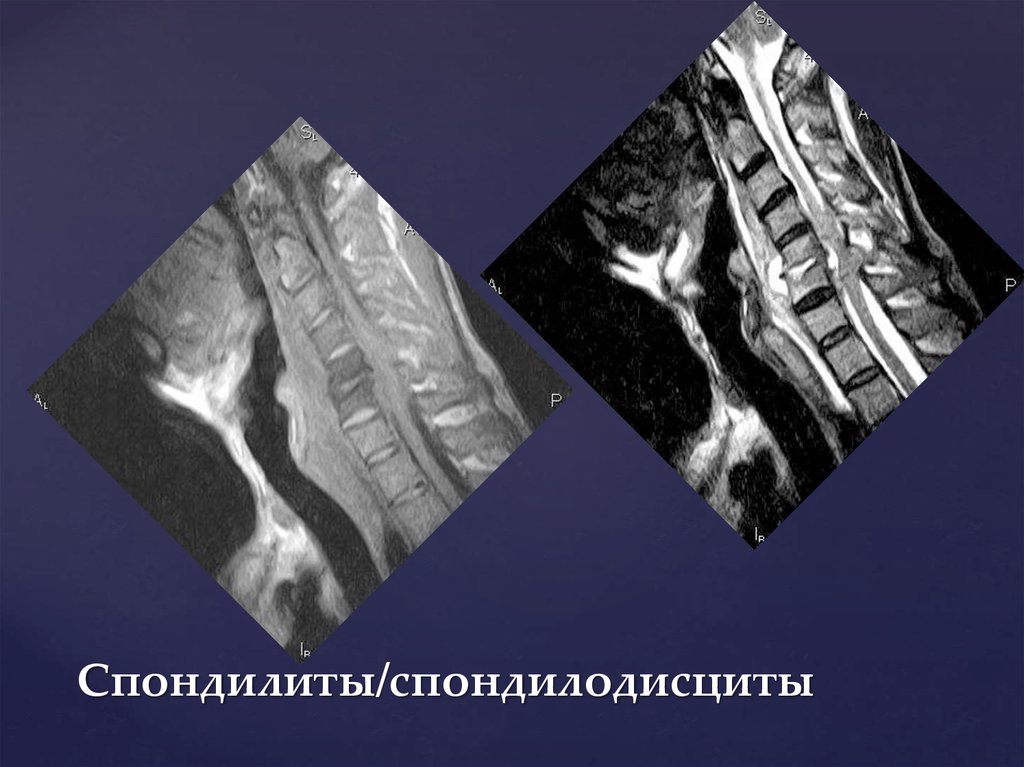 Спондилодисцит мрт картина