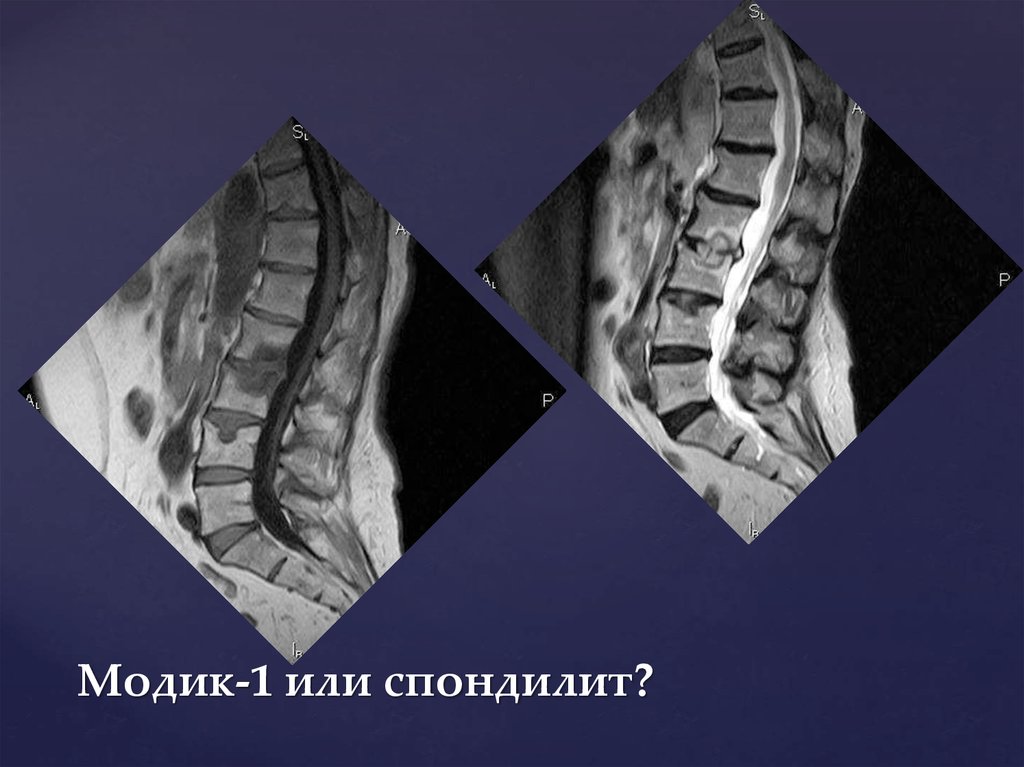 Модик 1. Modic мрт. Асептический спондилит. Спондилит мрт. Модик 1 спондилит мрт.