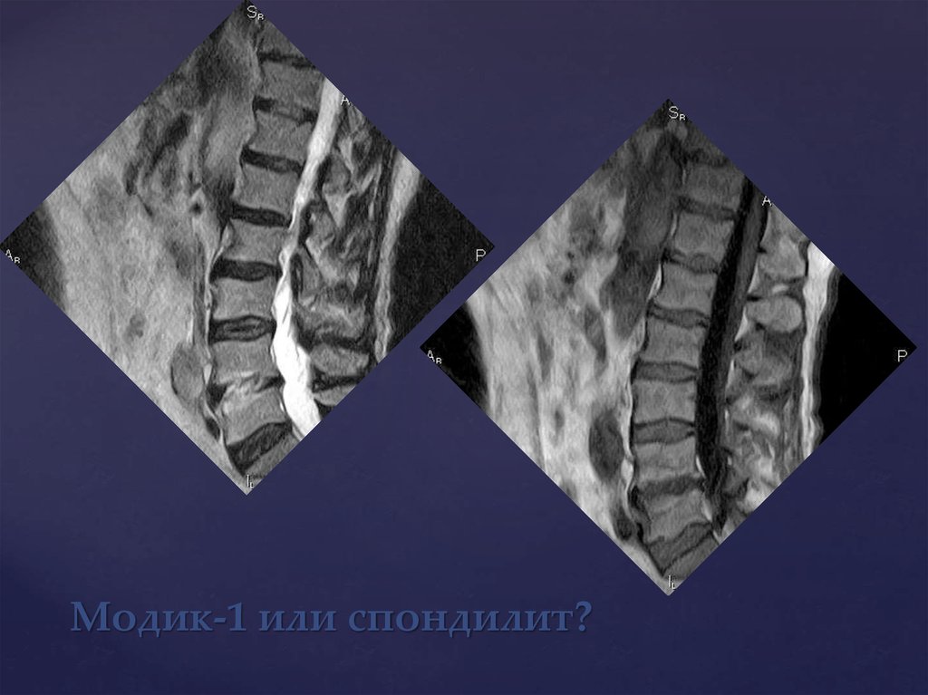 Модик 1. Отек костного мозга Modic Тип 1. Асептическое воспаление костного мозга Modic Тип 1. Модик 1 спондилит мрт. Модик 1 и модик 2.