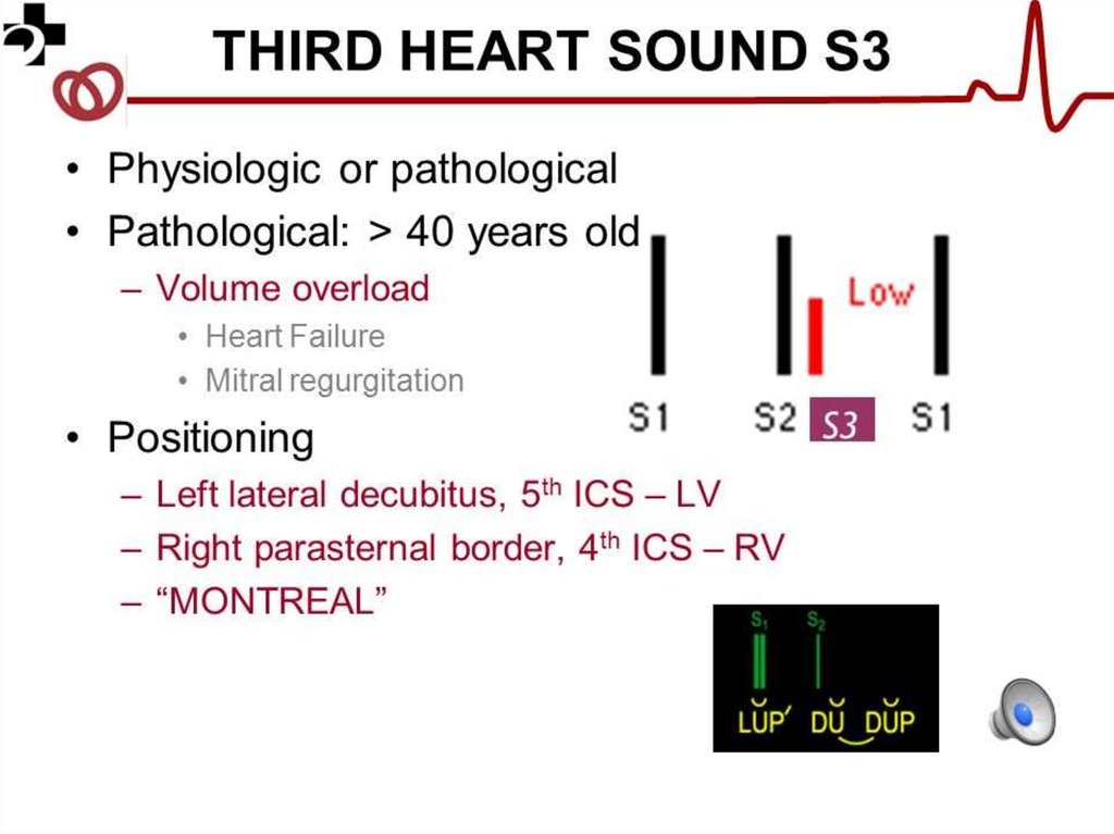 Three sound. S3 Heart Sound. Sound s. S3 vs s4 Sound Cardiac. Physiological s3 Heart Sound.