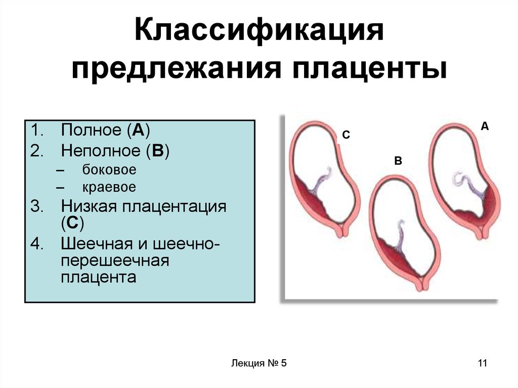 Патологическое прикрепление плаценты предлежание и врастание плаценты. Центральное боковое и краевое предлежание плаценты. Предлежание плаценты классификация. Плацента краевое предлежание плаценты. Неполное предлежание плаценты.