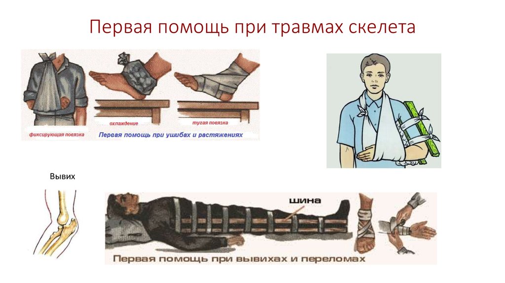 Презентация первая помощь при травмах опорно двигательной системы