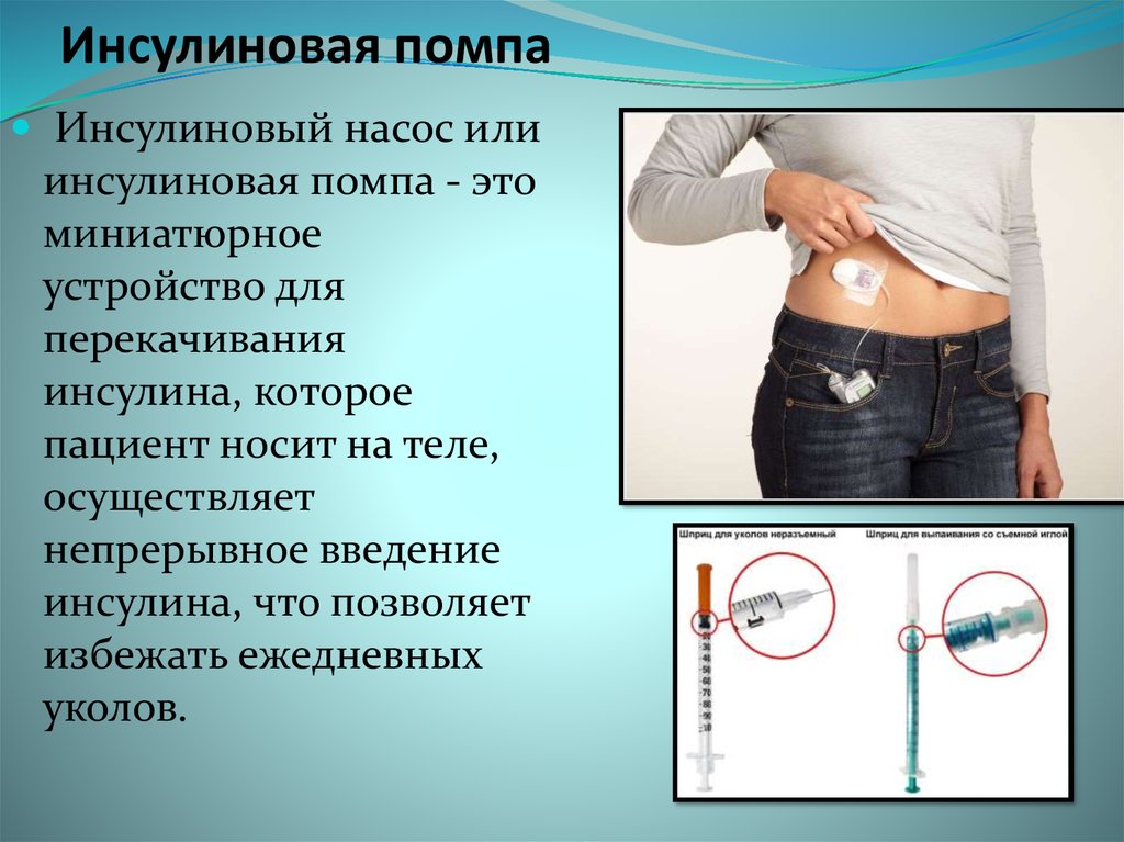 Инсулиновые помпы презентация