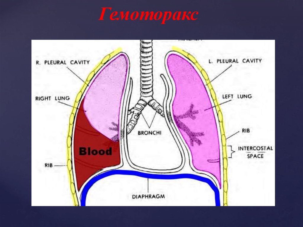 Гемоторакс клиническая картина