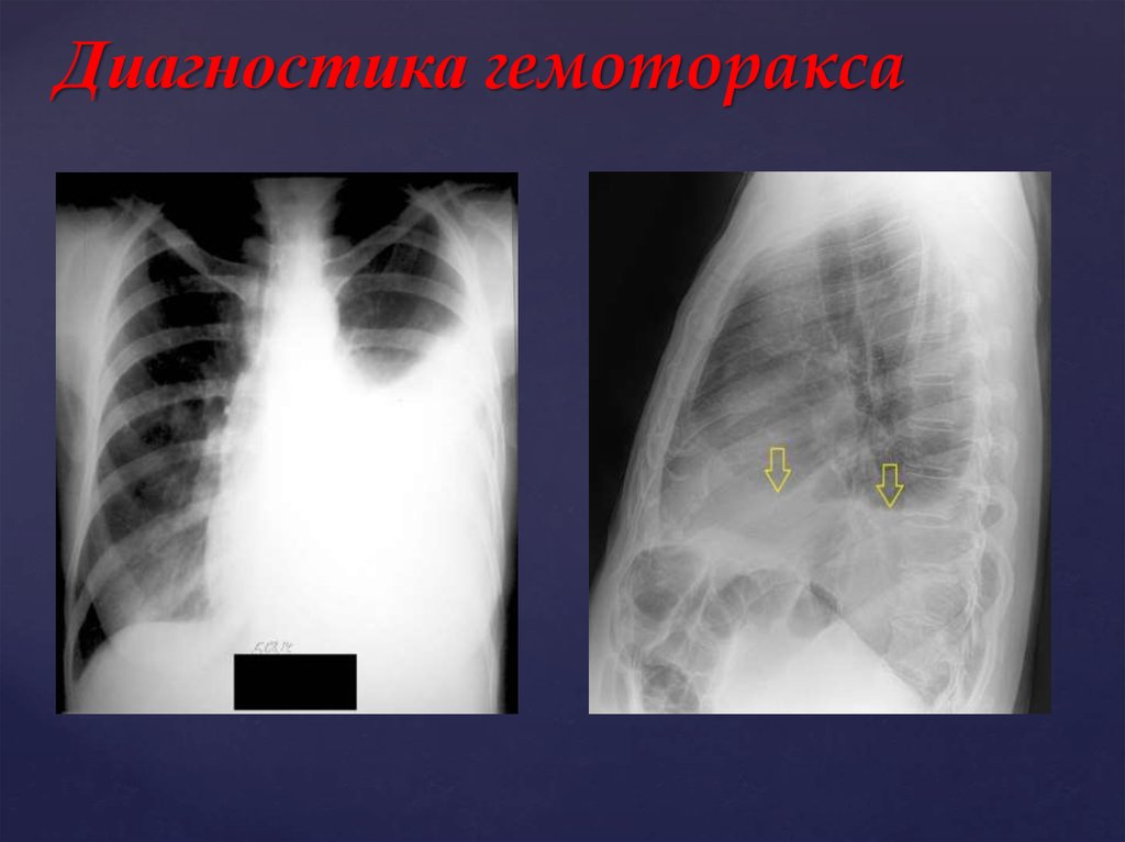 Гемоторакс клиническая картина