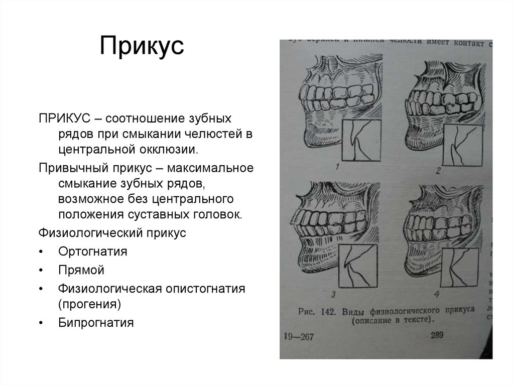 Центральной окклюзии зубной. Артикуляция окклюзия прикус. Понятие окклюзии и артикуляции. Окклюзия и артикуляция в ортопедической стоматологии. Положение зубов в центральной окклюзии это.