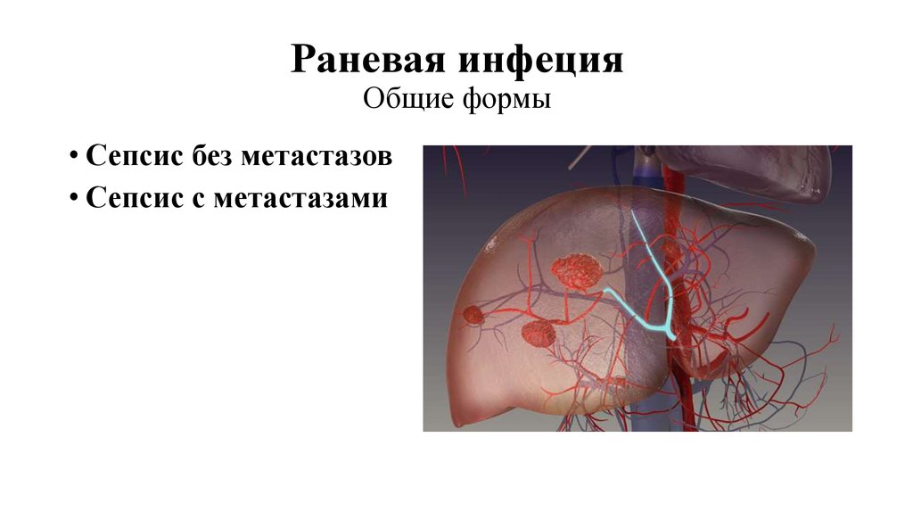 Раневая инфеция Общие формы