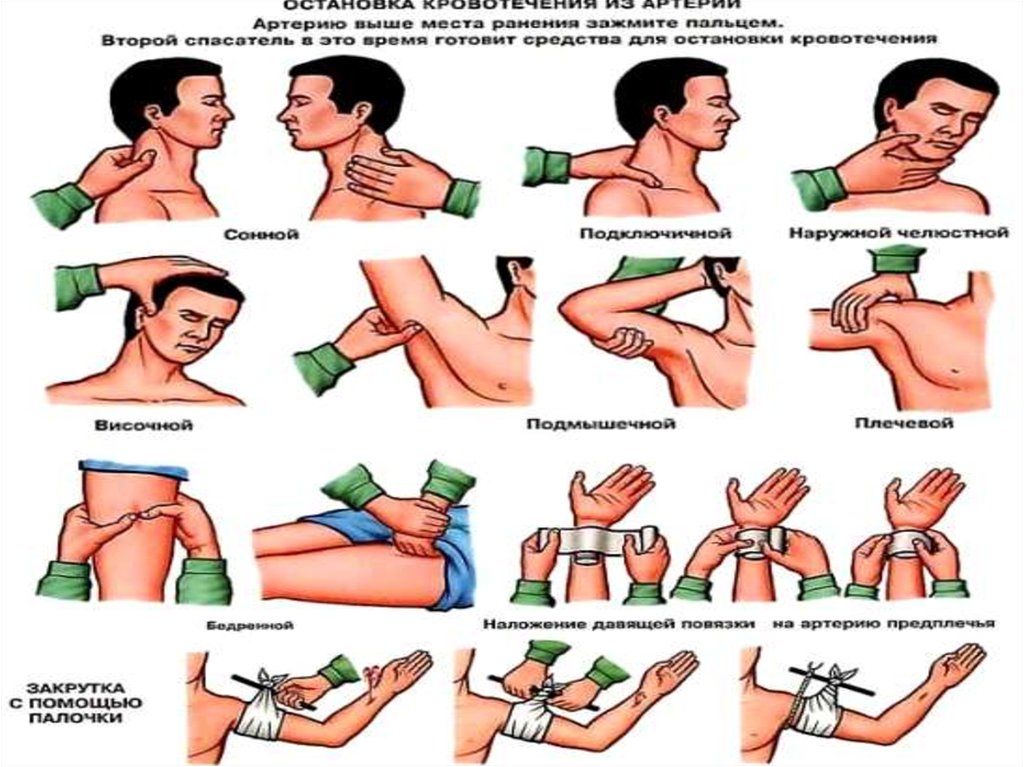 Оказание первой доврачебной помощи при кровотечении презентация