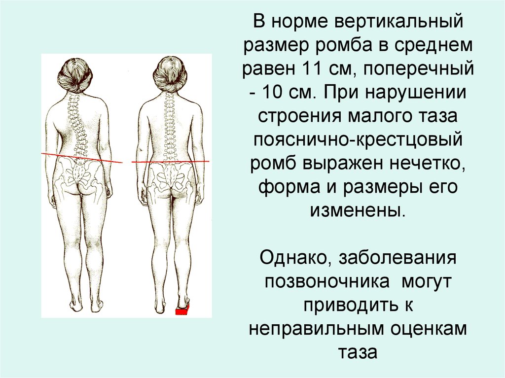 Вертикальный размер. Форма и Размеры ромба Михаэлиса норма. Размеры ромба Михаэлиса в норме. Пояснично крестцовый ромб Михаэлиса норма. Измерение пояснично крестцового ромба.