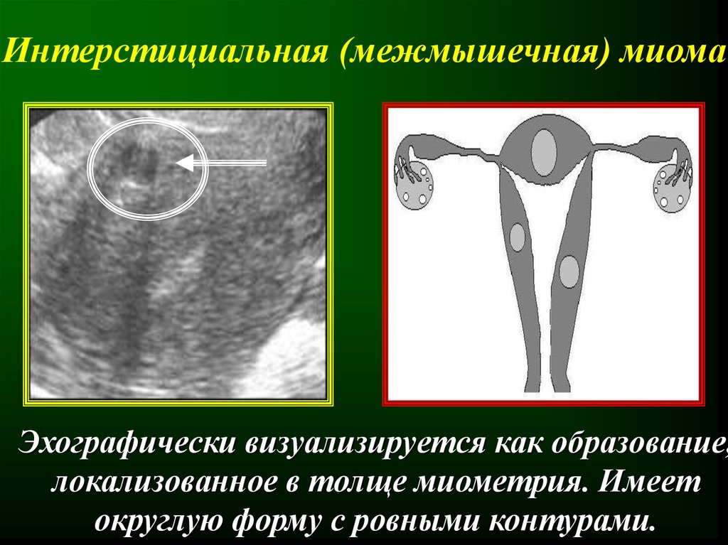 Можно заниматься спортом при миоме матки. Интерстициальный узел. Интерстициальная миома. Интерстициальная миома матки что это такое. Миома матки интерстициальная форма что это.