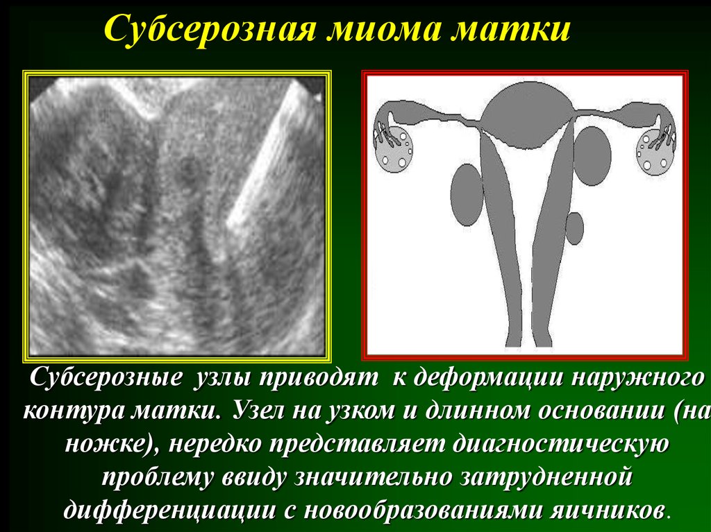 Клиническая картина миомы матки