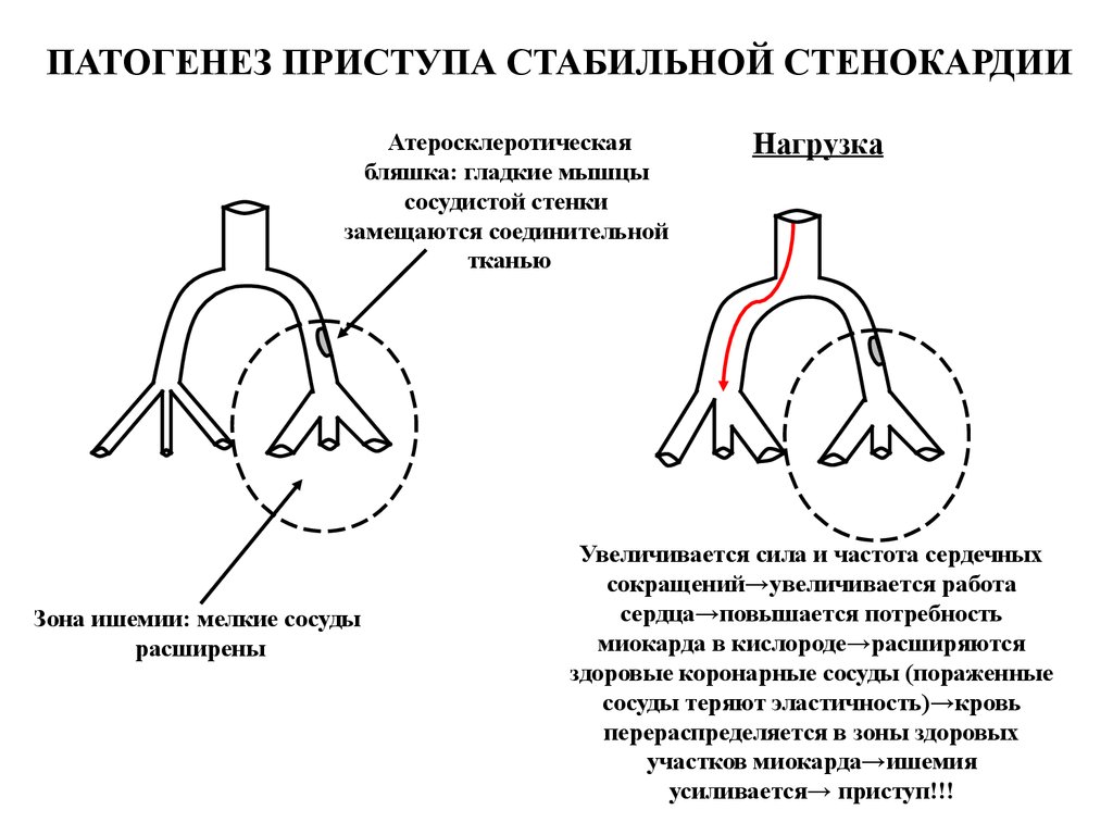 Стенокардия этиология. Механизм развития боли при стенокардии. Патогенез стабильной стенокардии напряжения. Патогенез нестабильной стенокардии схема. Патогенез стенокардии патофизиология.