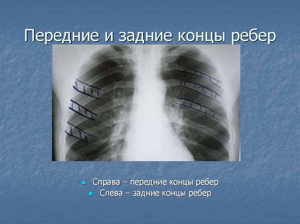 Отрезки ребер. Ребра на рентгене передние и задние отрезки. Передний отрезок ребра на рентгене. Передние и задние концы ребер. Передние отрезки ребер на рентгенограмме.