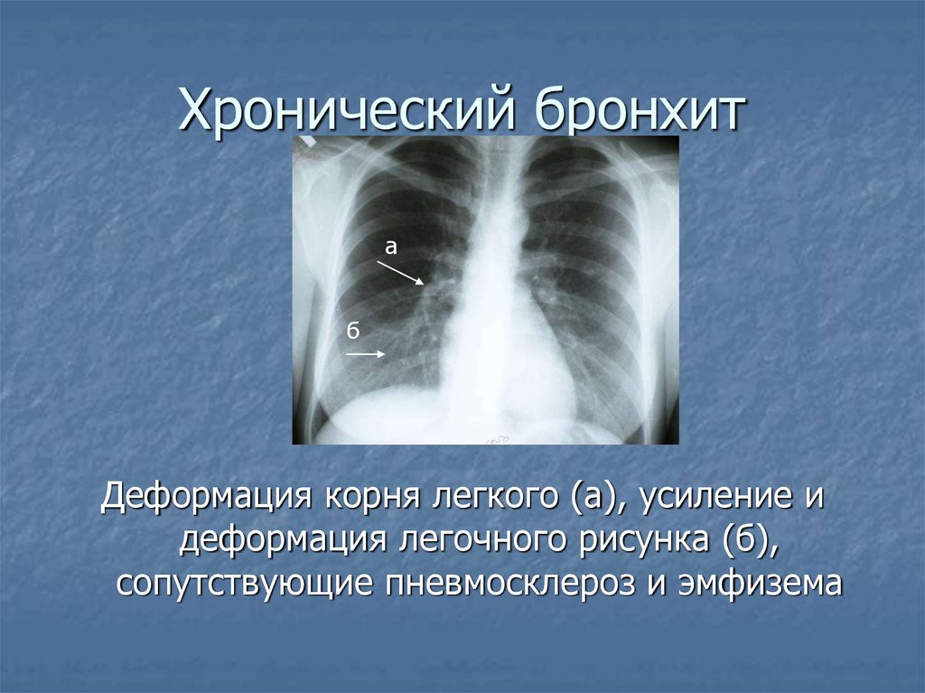 Что означает легочный рисунок. Рентген ОГК при хроническом бронхите. Деформация легочного рисунка. Легочный рисунок деформирован. Усиление и деформация легочного рисунка.