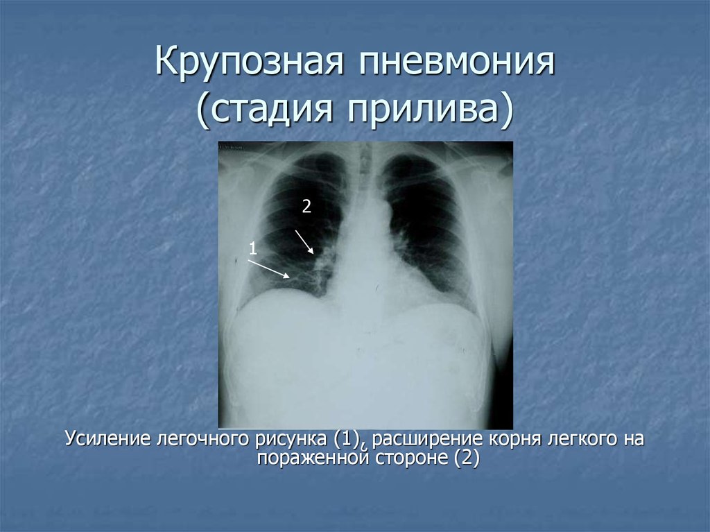 Стадии пневмонии. Крупозная пневмония стадия прилива рентген. Пневмония стадия прилива рентген. Крупозная пневмония рентген. Стадии крупозной пневмонии.