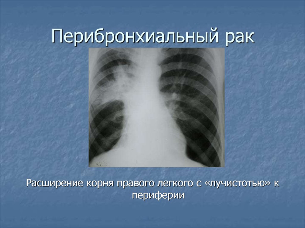 Рак центрального правого. Центральное образование правого легкого рентген. Перибронхиальная опухоль. Образование корня легкого. Перибронхиально Узловая форма.