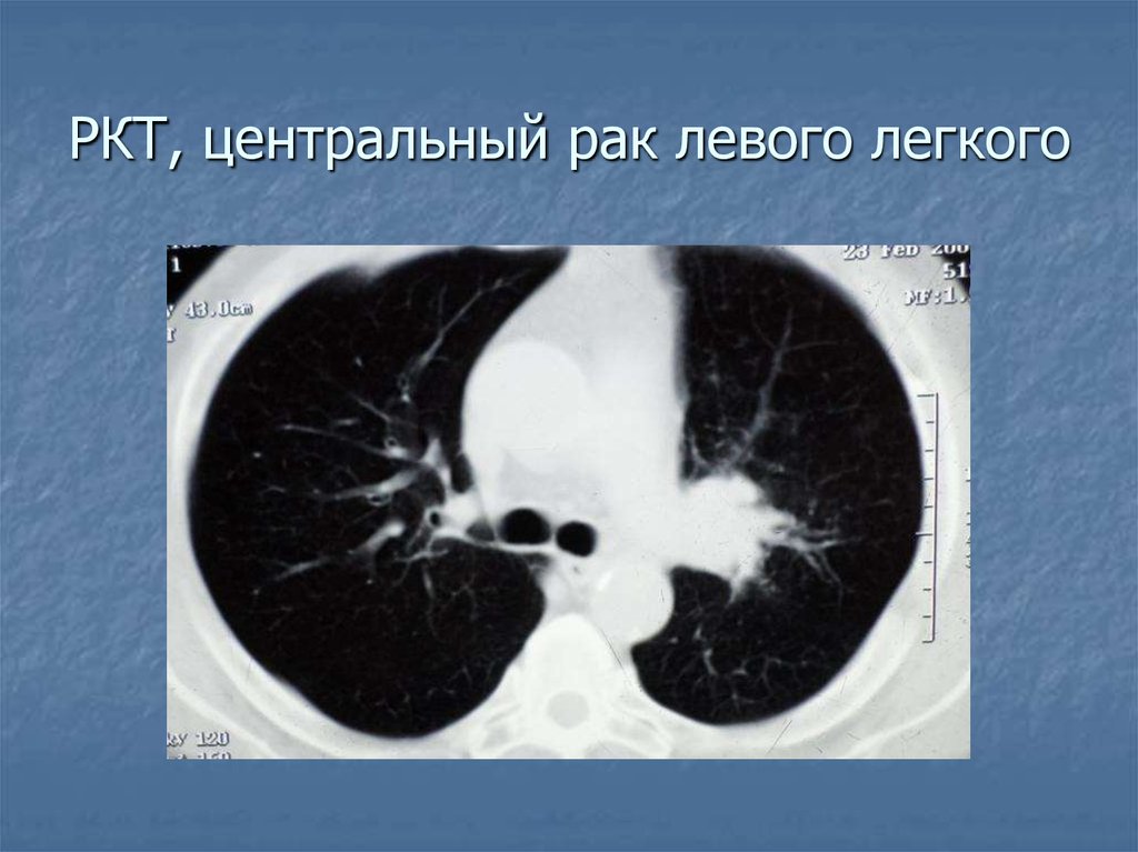 Центральный рак правого. РКТ легких. Рентгеновская томография легких. Корень легкого на кт.