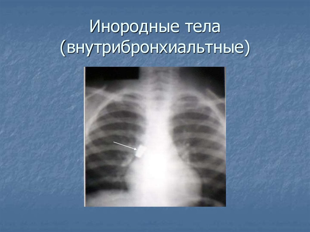 Инородные тела дыхательных путей причины. Инородное тело в дыхательных путях рентген. Рентген дыхательных путей. Инородные тела верхних дыхательных путей рентген. Попадание инородного тела в бронхи.
