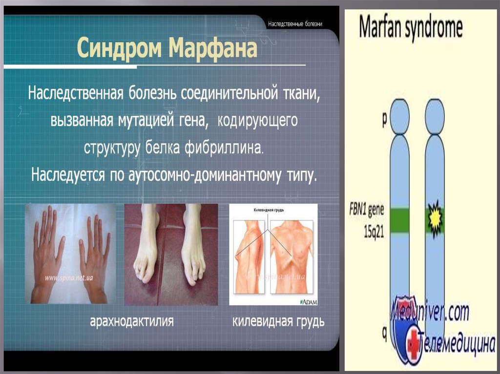 Синдром марфана фото больных