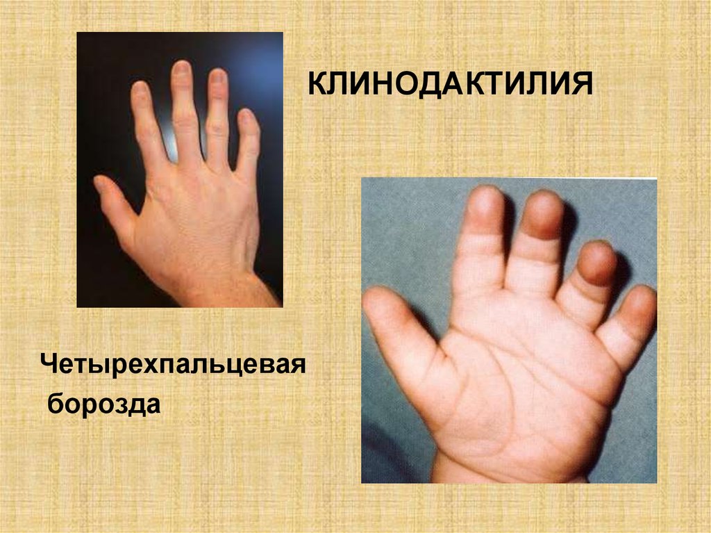 Перепонки между пальцами у мужчин. Клинодоктилия мкзинца. Клинодактилия мизинцев синдром.