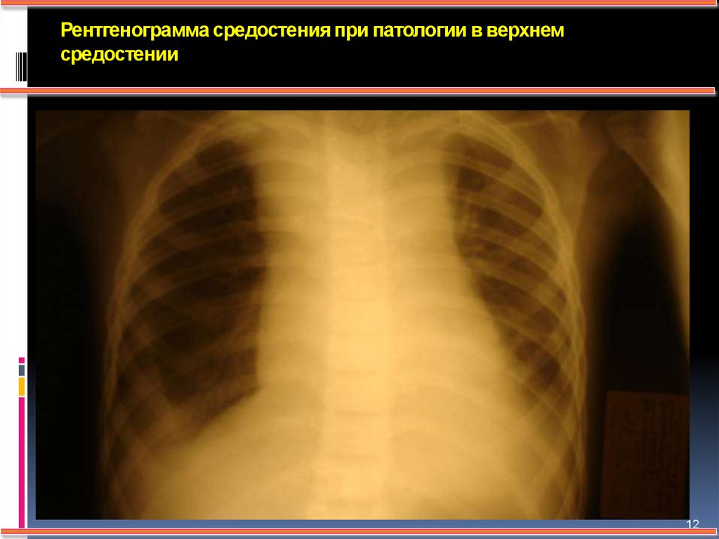 Расширение органа. Средостение на рентгенограмме. Расширение средостения. Патология средостения. Расширение средостения на рентгене.