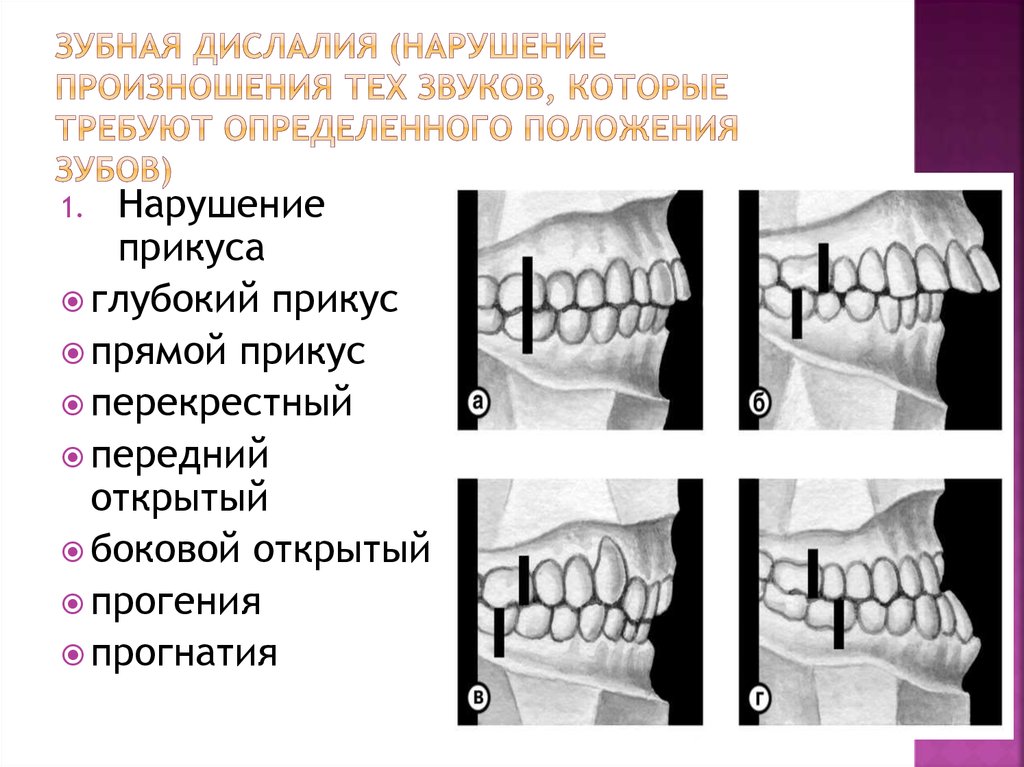 Сенсорная и моторная дислалия