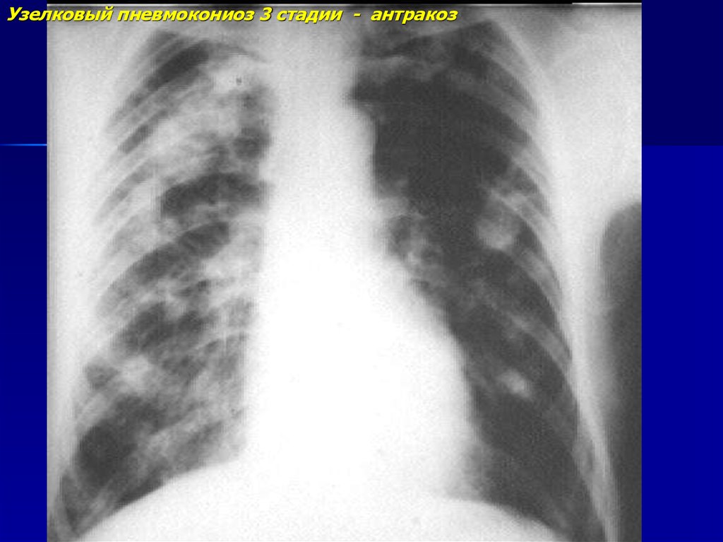 Пневмокониоз легких. Пневмокониоз легких симптомы. Пневмокониоз легких три стадии. Пневмокониоз 2 стадии. Узелковый Тип пневмокониоза.